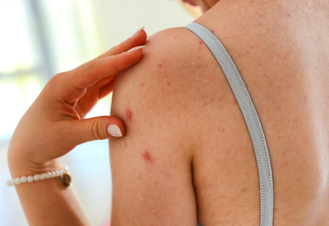 Tratamiento para la pitiriasis versicolor