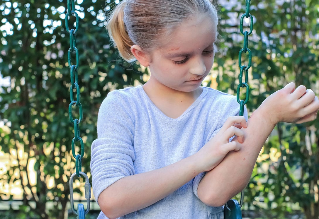 Dermatitis atópica en niños