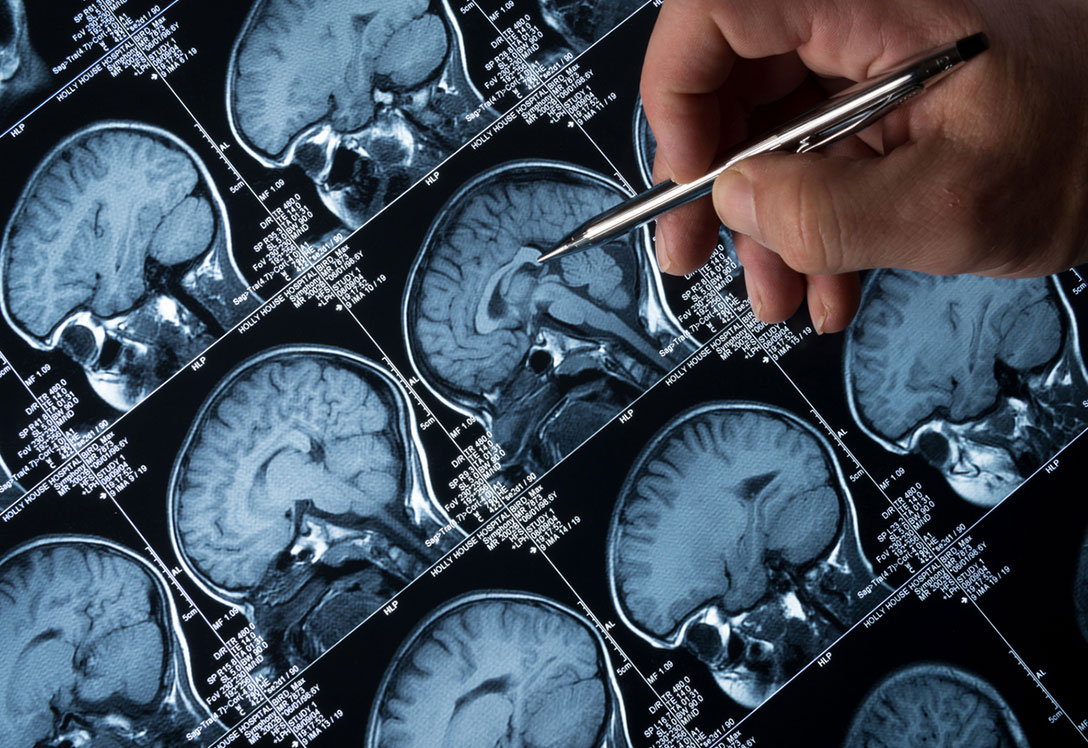 La epilepsia: trastorno del sistema nervioso neurológico central donde la actividad cerebral se vuelve anormal