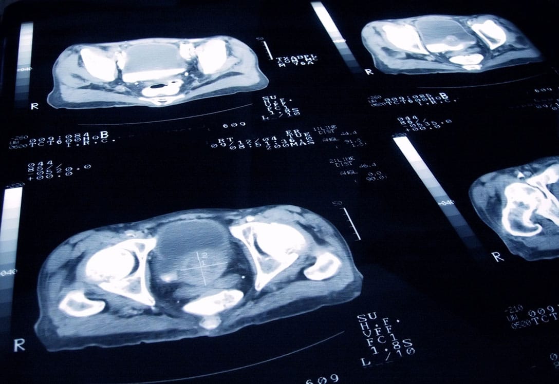 segunda opinión sobre el cáncer de próstata