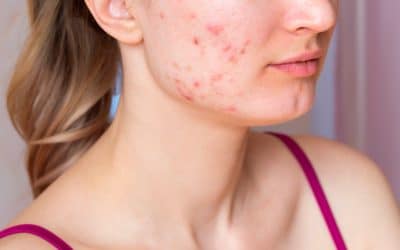 Tratamientos, causas y tipos de acné en adultos