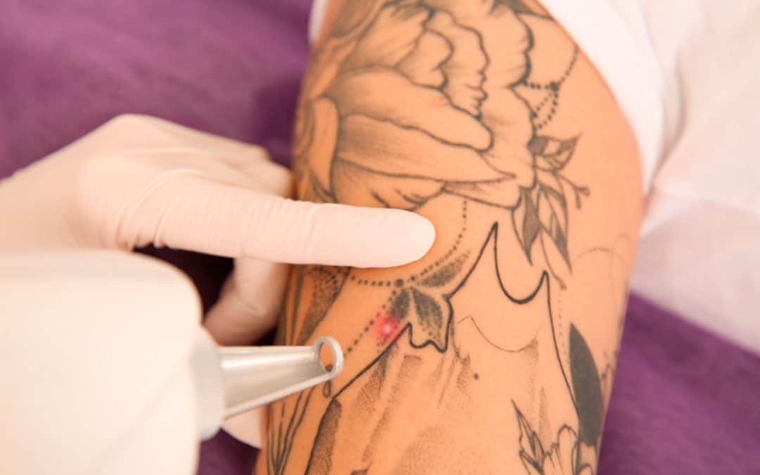 Métodos para eliminar tatuajes