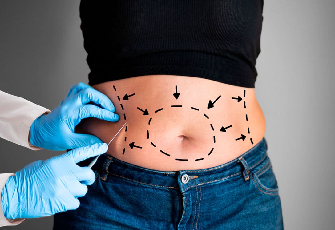evaluacion-paciente-lipoescultura Paciente siendo evaluada para lipoescultura