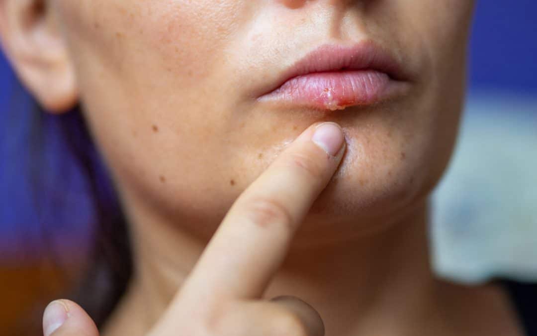 Herpes labial- consecuencias y tratamiento del herpes labial