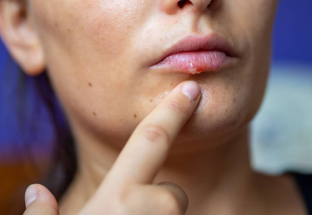 Ejemplo de un herpes labial