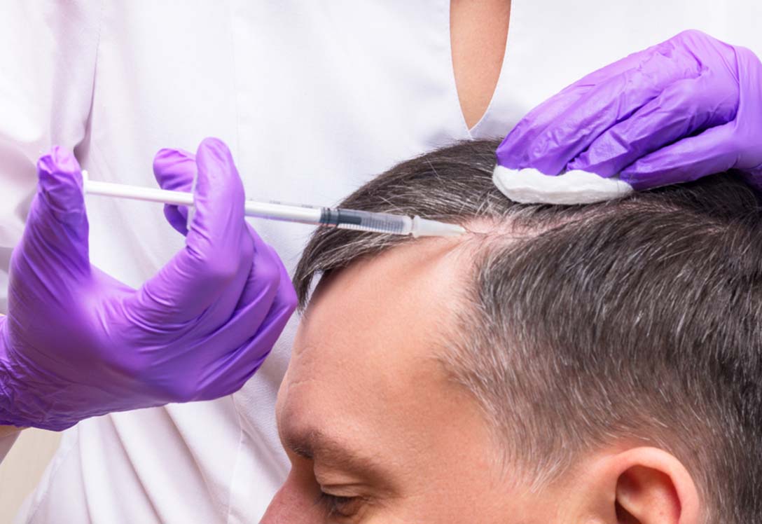 Hombre recibiendo tratamiento contra caída del cabello