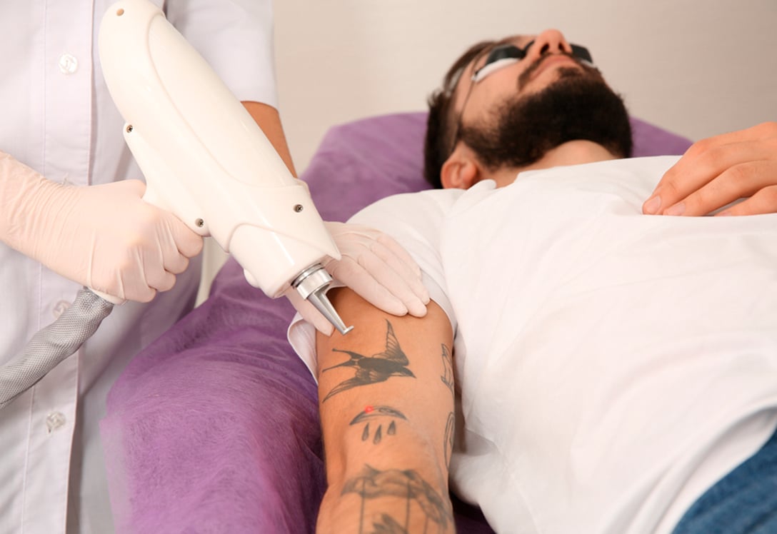 joven-proceso-eliminar-tatuaje Joven en proceso de eliminación de tatuaje.