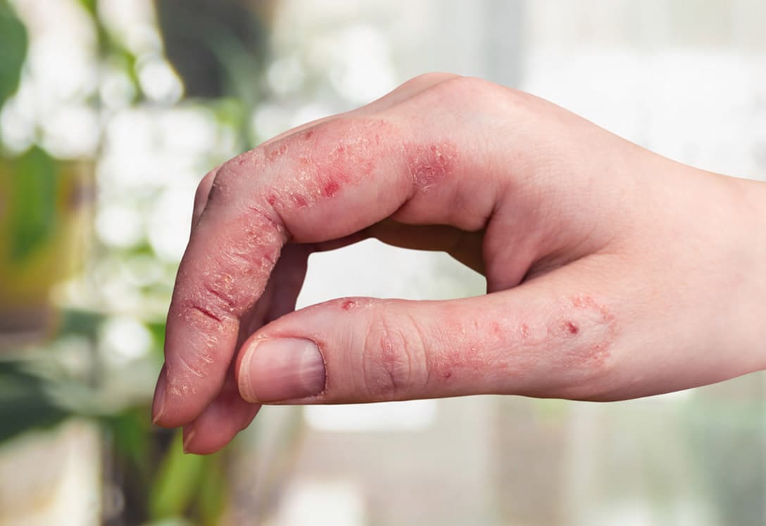 manos-afectadas-psoriaris Manos afectada por psoriasis