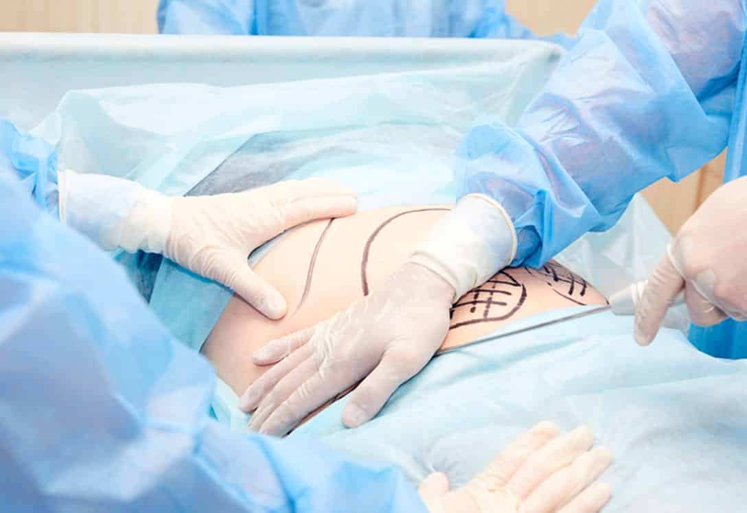 Paciente sometida a cirugía de liposucción