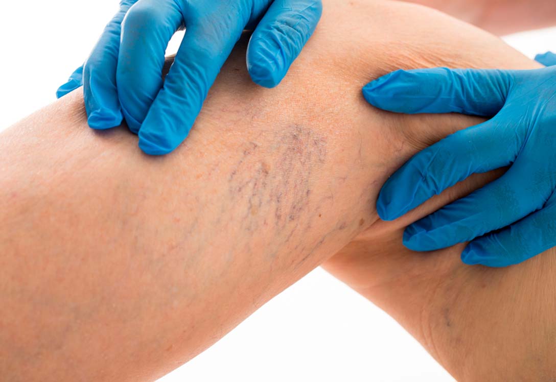 Paciente con varices en las piernas