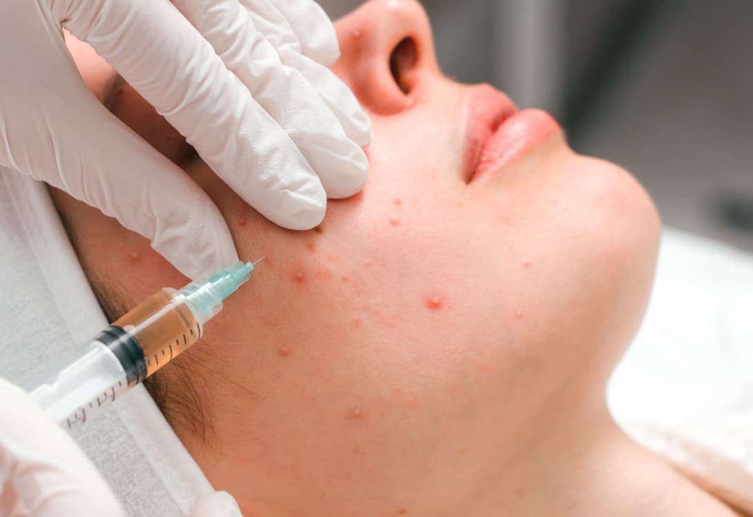 tratamiento-facial-contra-acne Tratamiento facial contra el acné