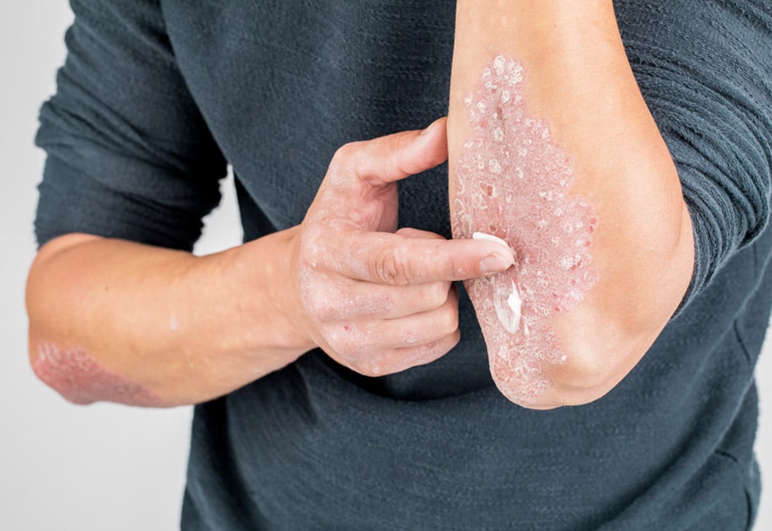 Apliacación de crema emoliente para la psoriasis